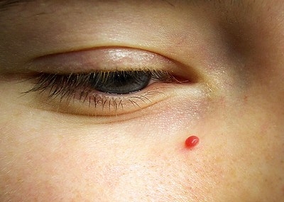 Removal - Blood Spot (per spot)