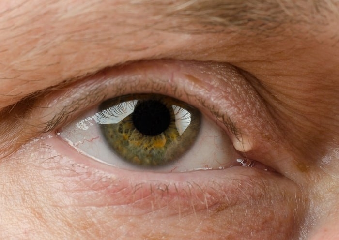 Removal - 1 x Eye Cyst