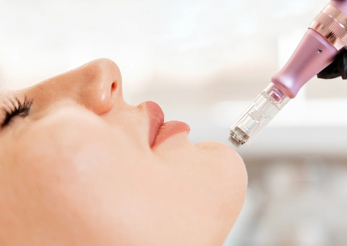 Microneedling Hyaluronic Acid - Reduces Fine Lines
