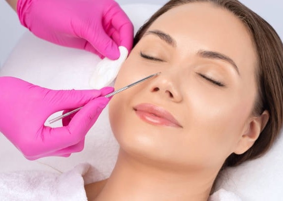 Removal - Blackhead Extraction 30 Mins