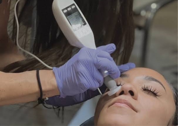 Cool Plasma + IPL - Rosacea / Pigmentation