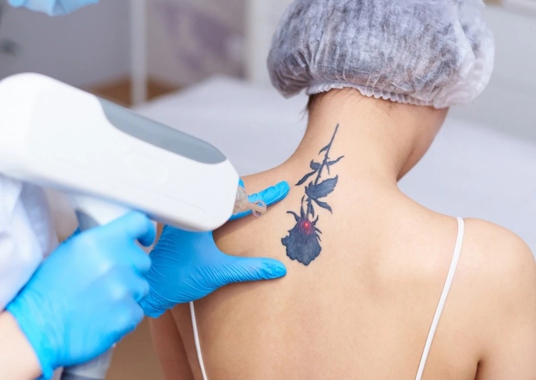 Removal - Medium Tattoo Session 10cm