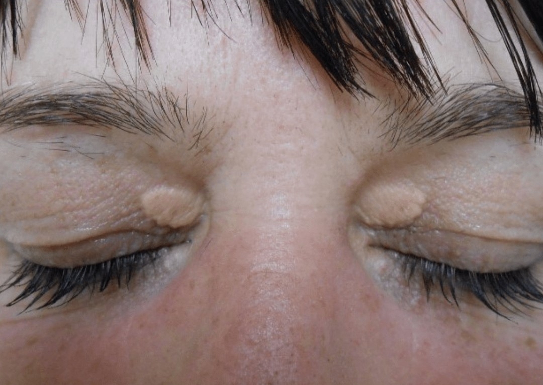 Removal - Xanthelasma Top or Bottom Eye Lids