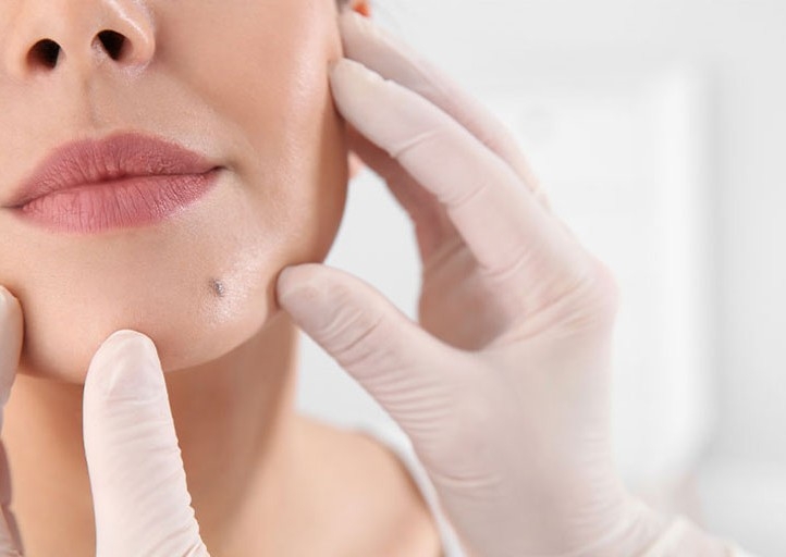 Removal - 1 x Mole / Wart / Keratosis /Small Skin Cyst