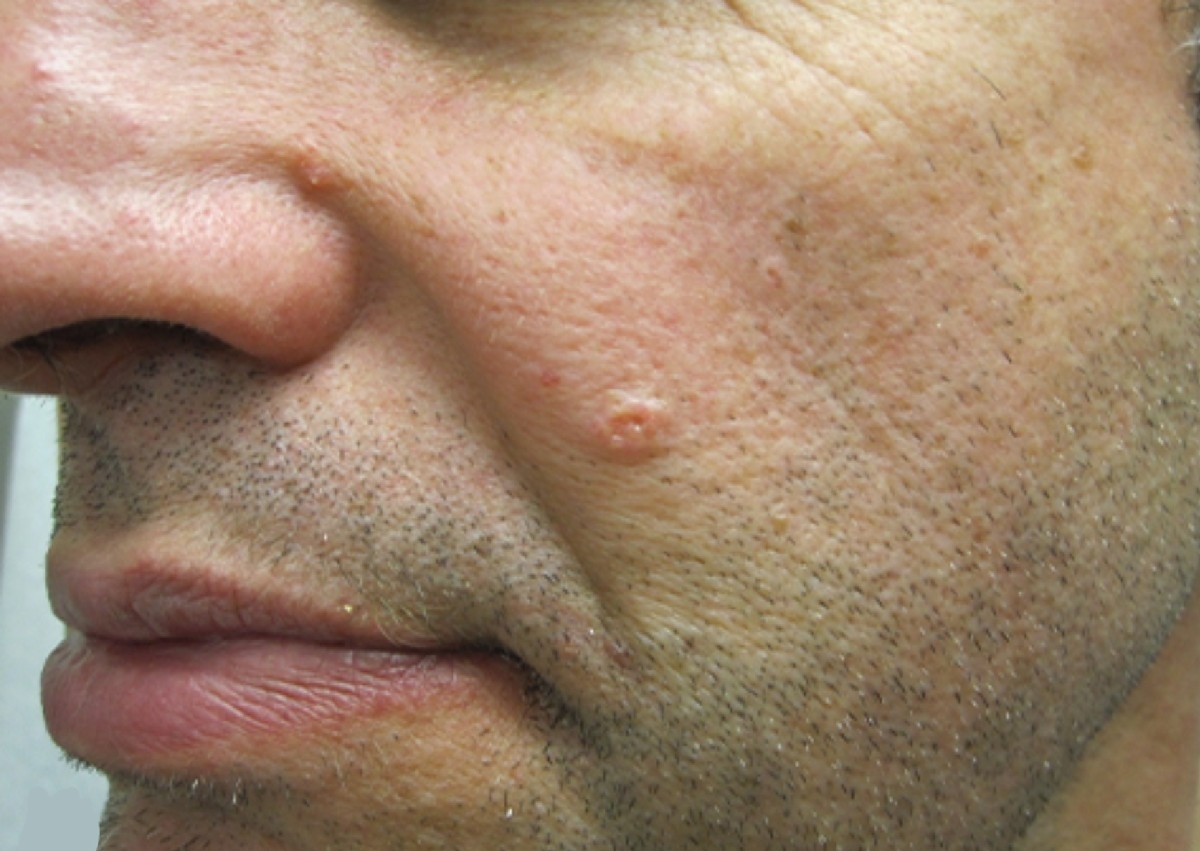 Removal - Sebaceous Hyperplasia