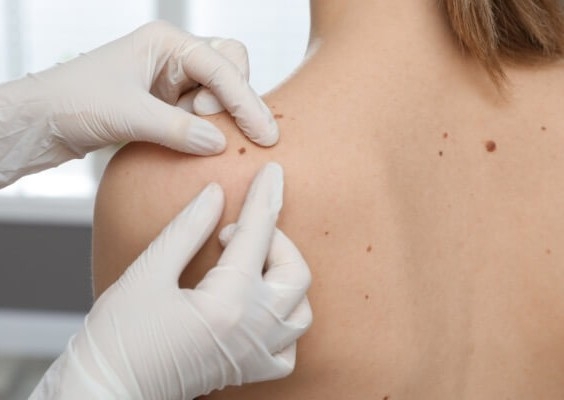 Removal - 6 - 10 Skin Tags