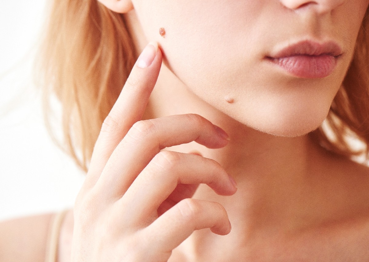 Removal - 2 x Mole / Wart / Keratosis / Small Skin Cyst