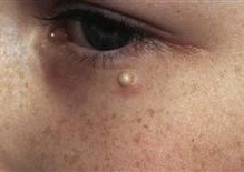 Removal - 2 x Eye Cyst