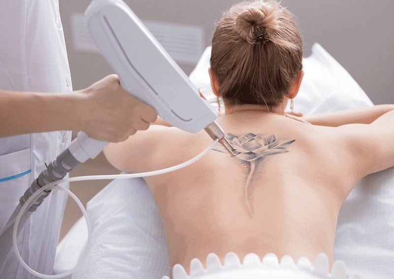 Removal - Large Tattoo Session 15cm+