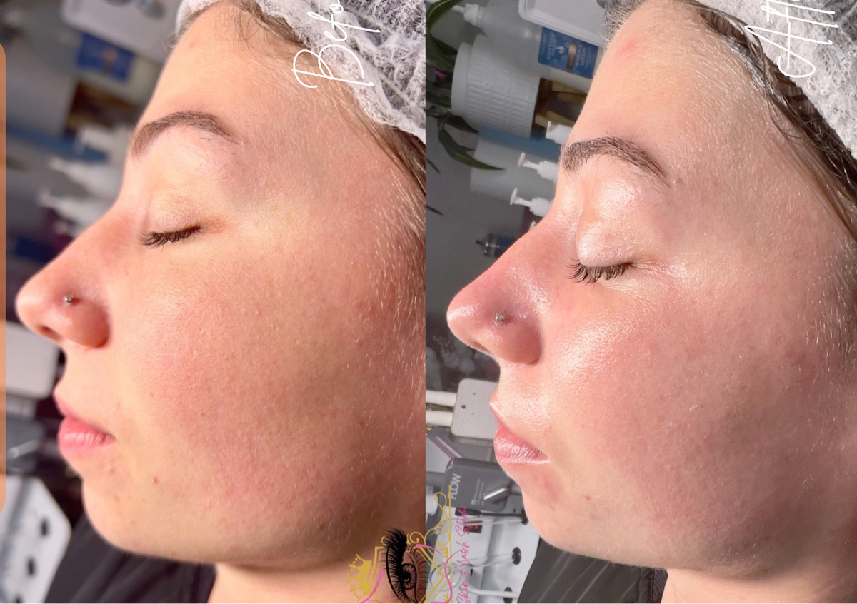 Microderm - Diamond Glow LED Facial