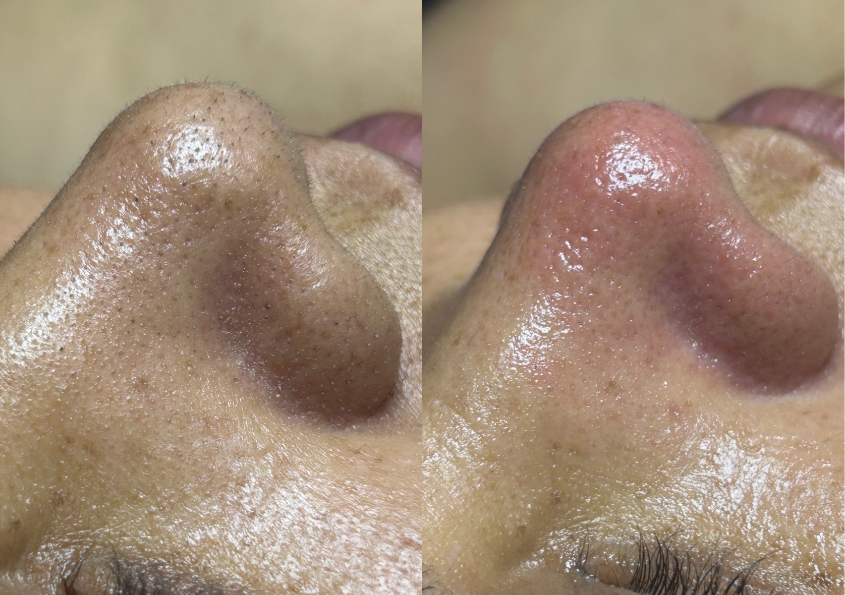 Extractions ( Add On )