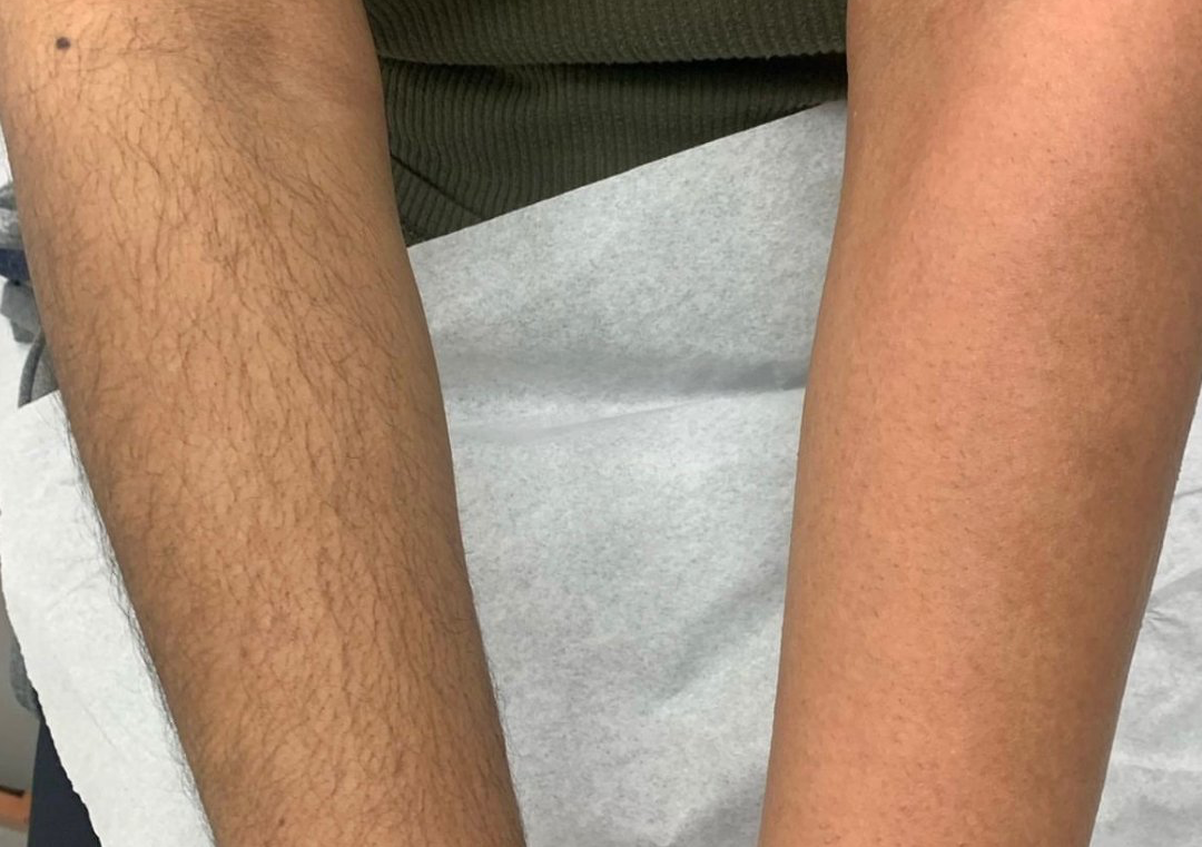 Full arms / Bras au Complet