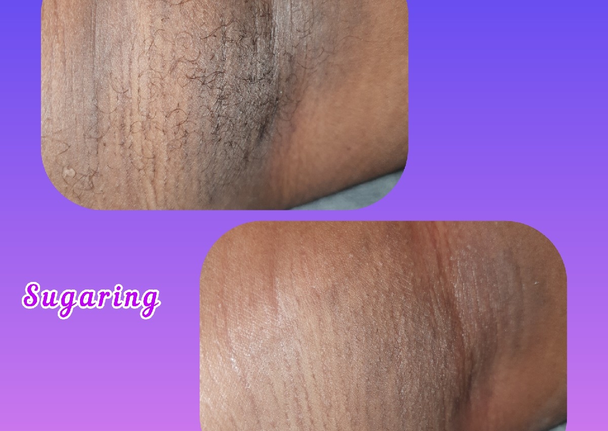 Oksels sugaring