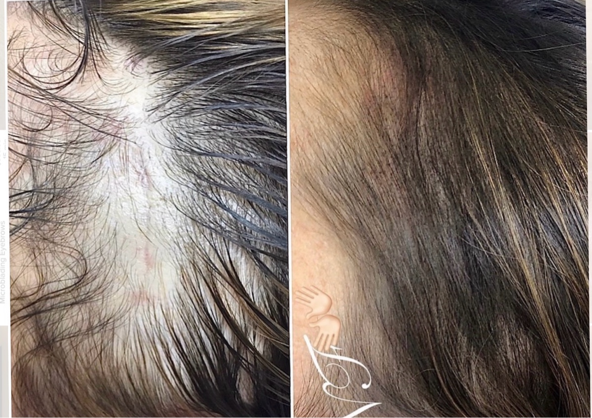 Scalp Micropigmentation 