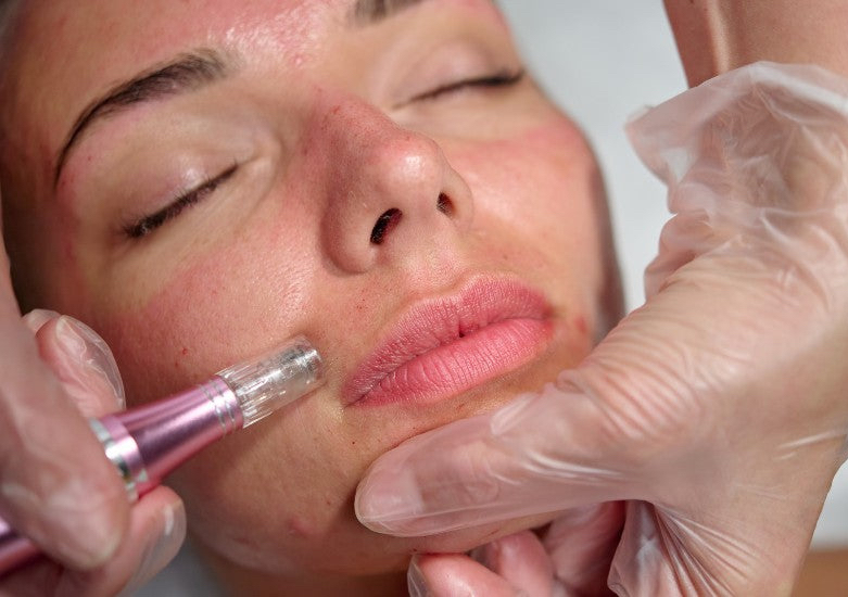 Microneedling