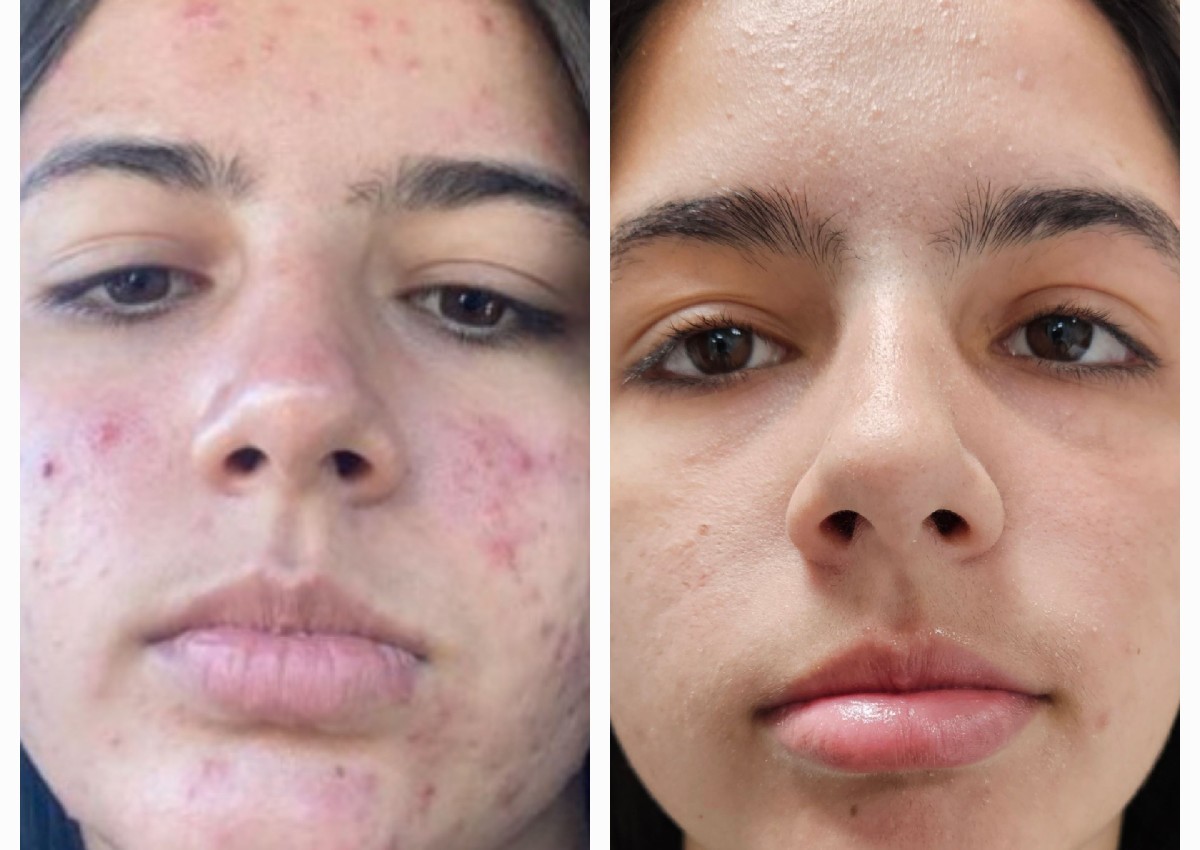 Facial w.  Blackhead extraction