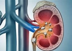 Kidney Stone