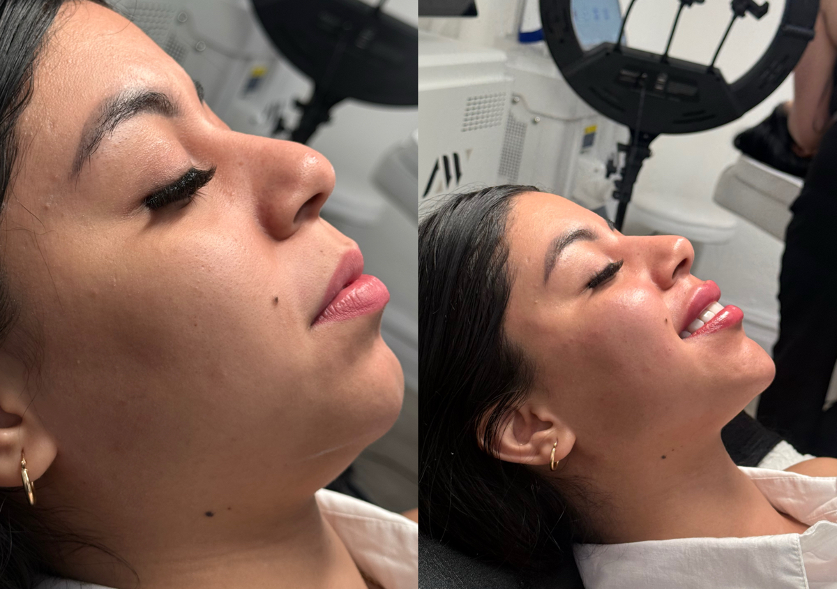Full face armonización facial!