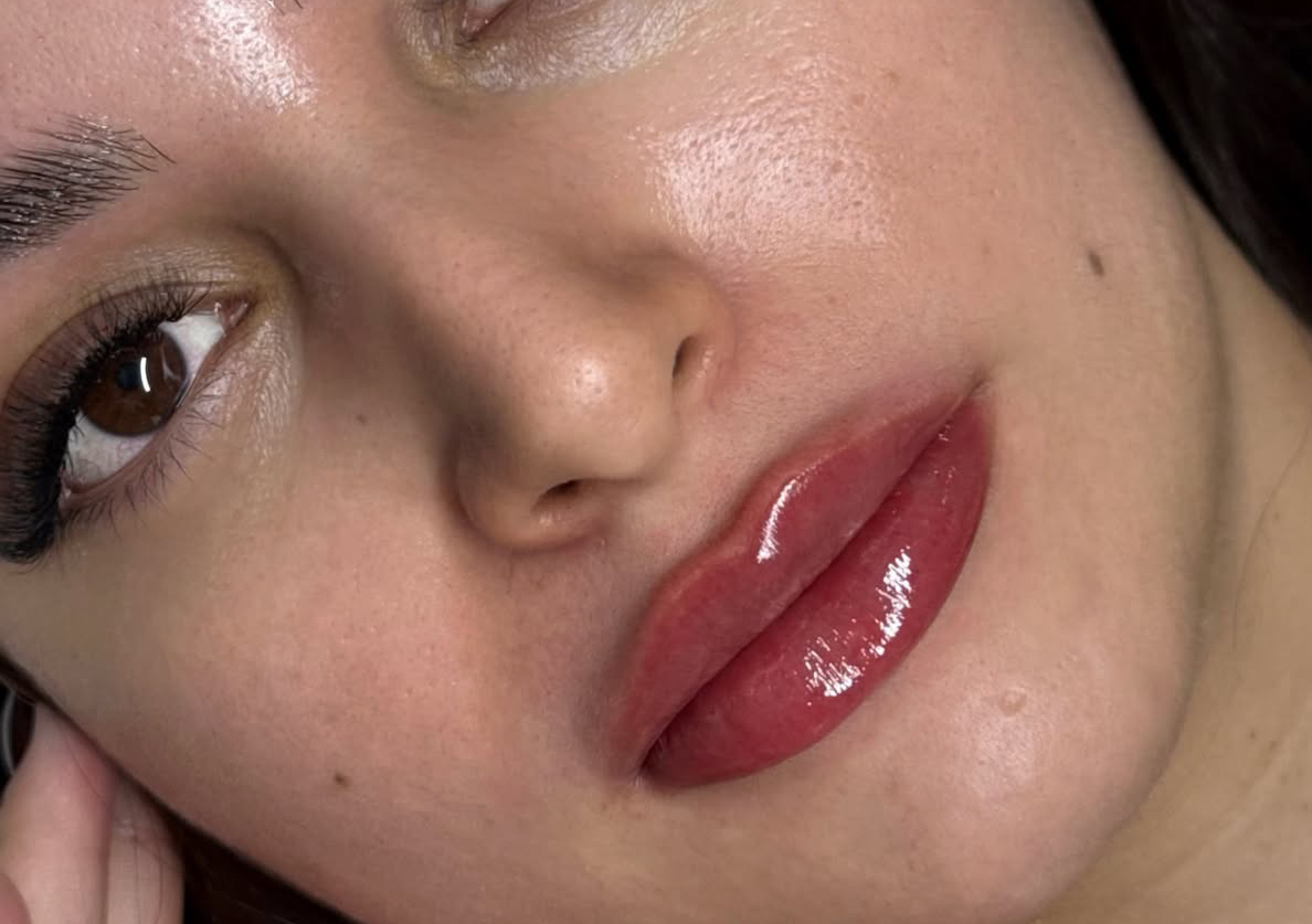 Lips fillers 1ml