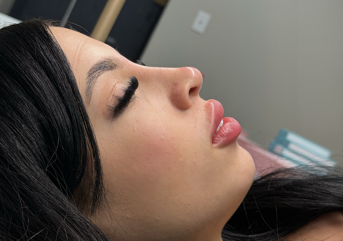Lip Filler+Rinomodelacion