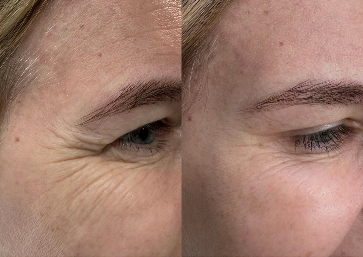 Botox-Innotox