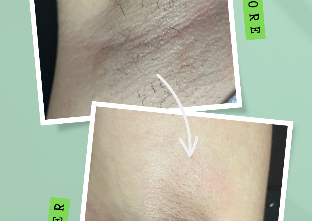 Evanesco (Depilacion en cera) Axilas 