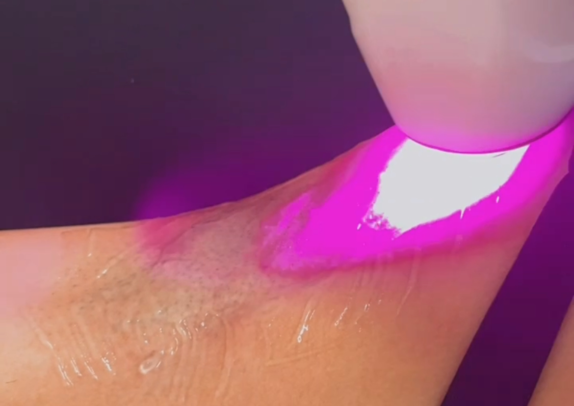 Laser Axilas 