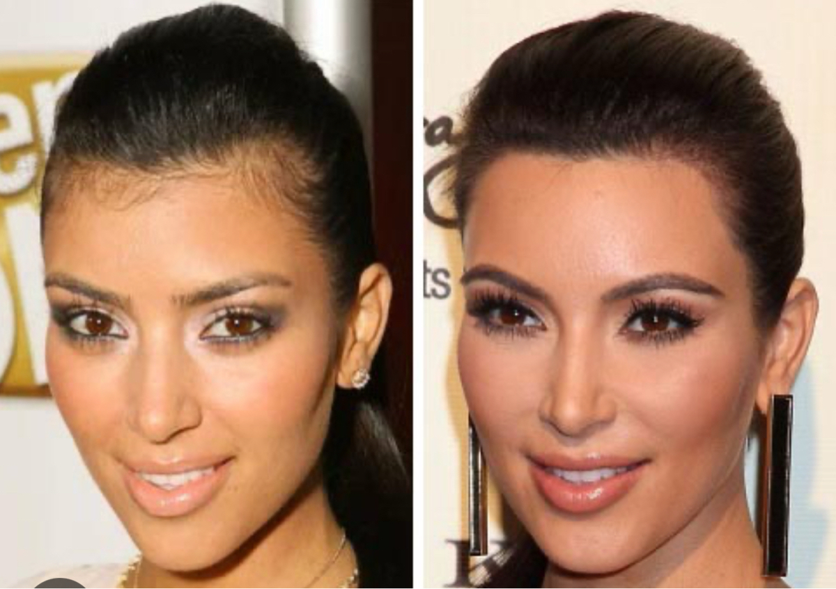 Sideburns or Hairline 