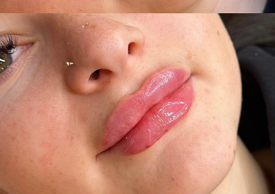 1.1ml lip filler 