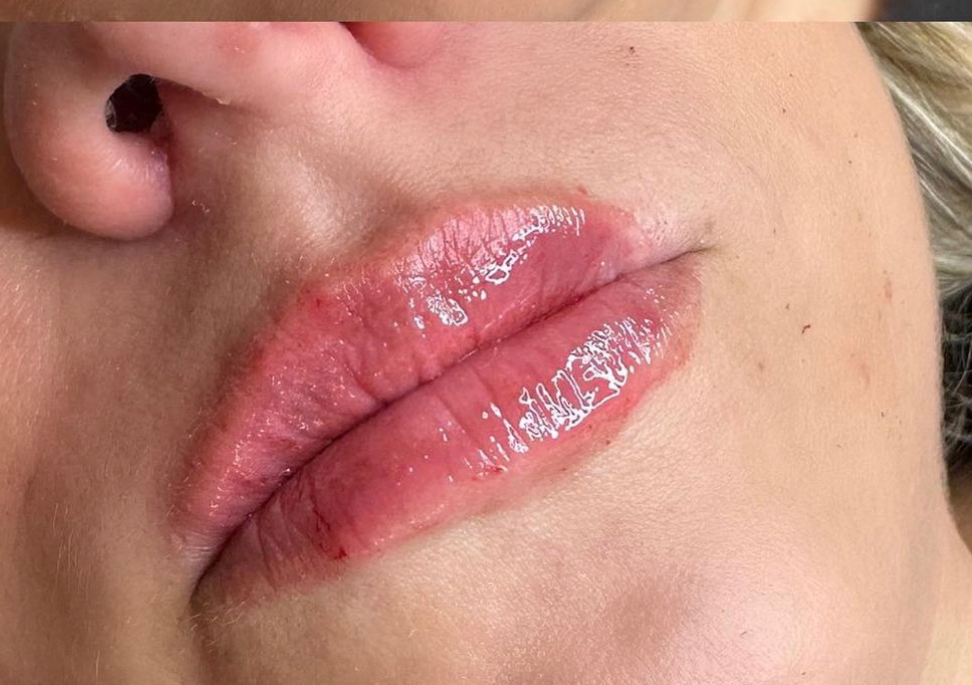 0.5ml lip filler 
