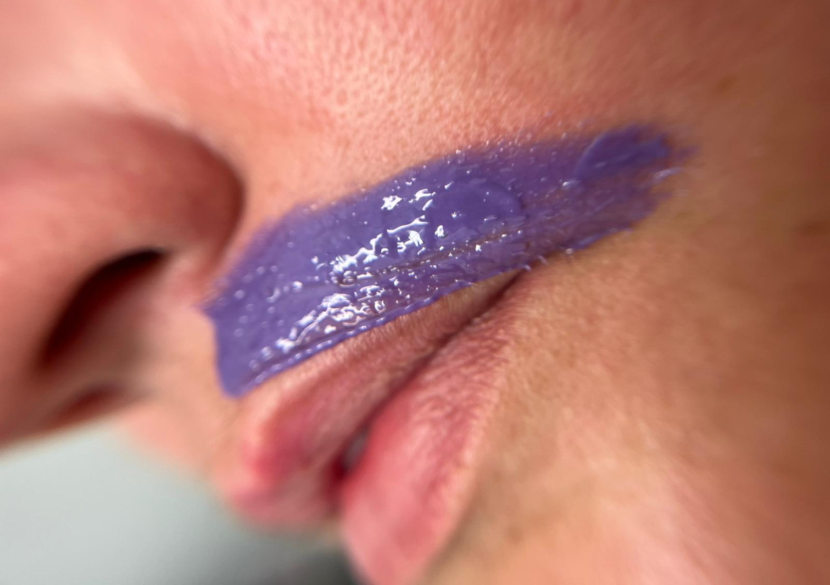 Epilación de Bozo (Bigote)