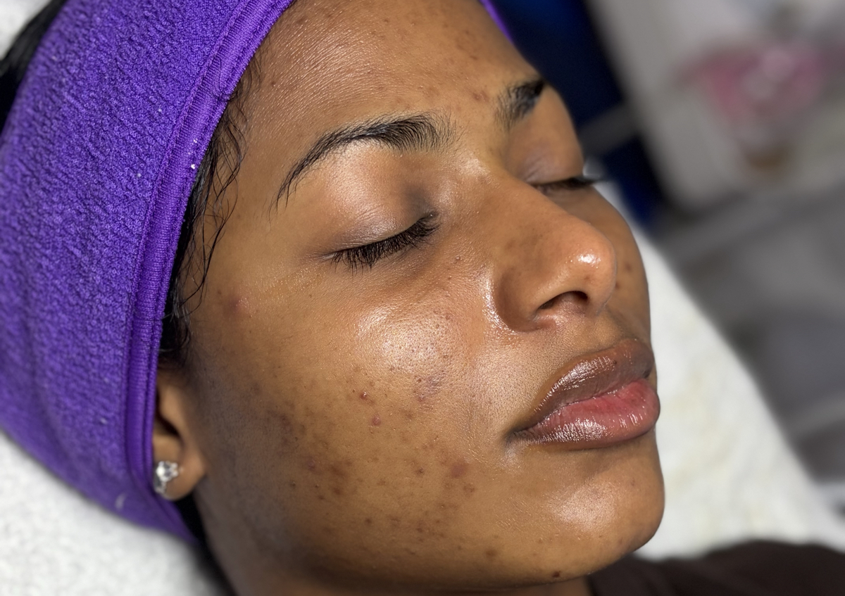 Paquete Exfoliación Química