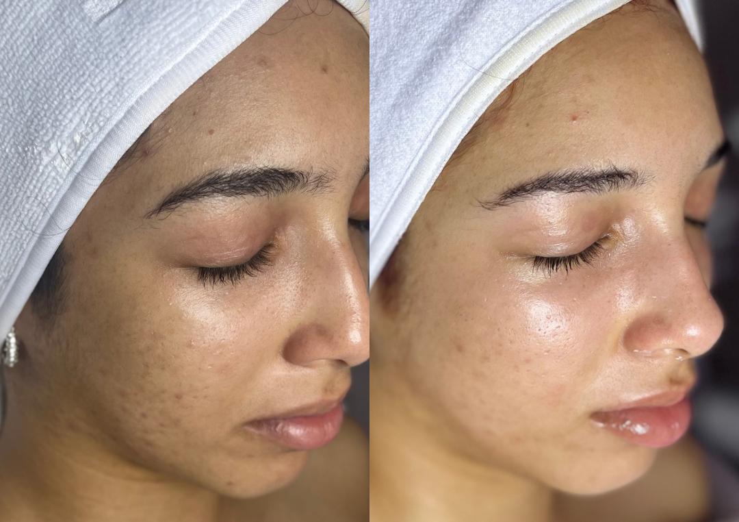 Microdermoabrasión en Facial