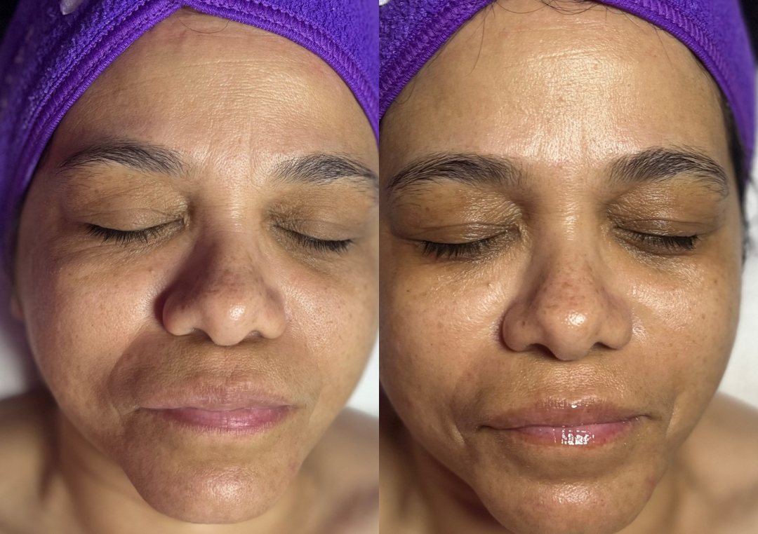 Microagujas & Exosomas