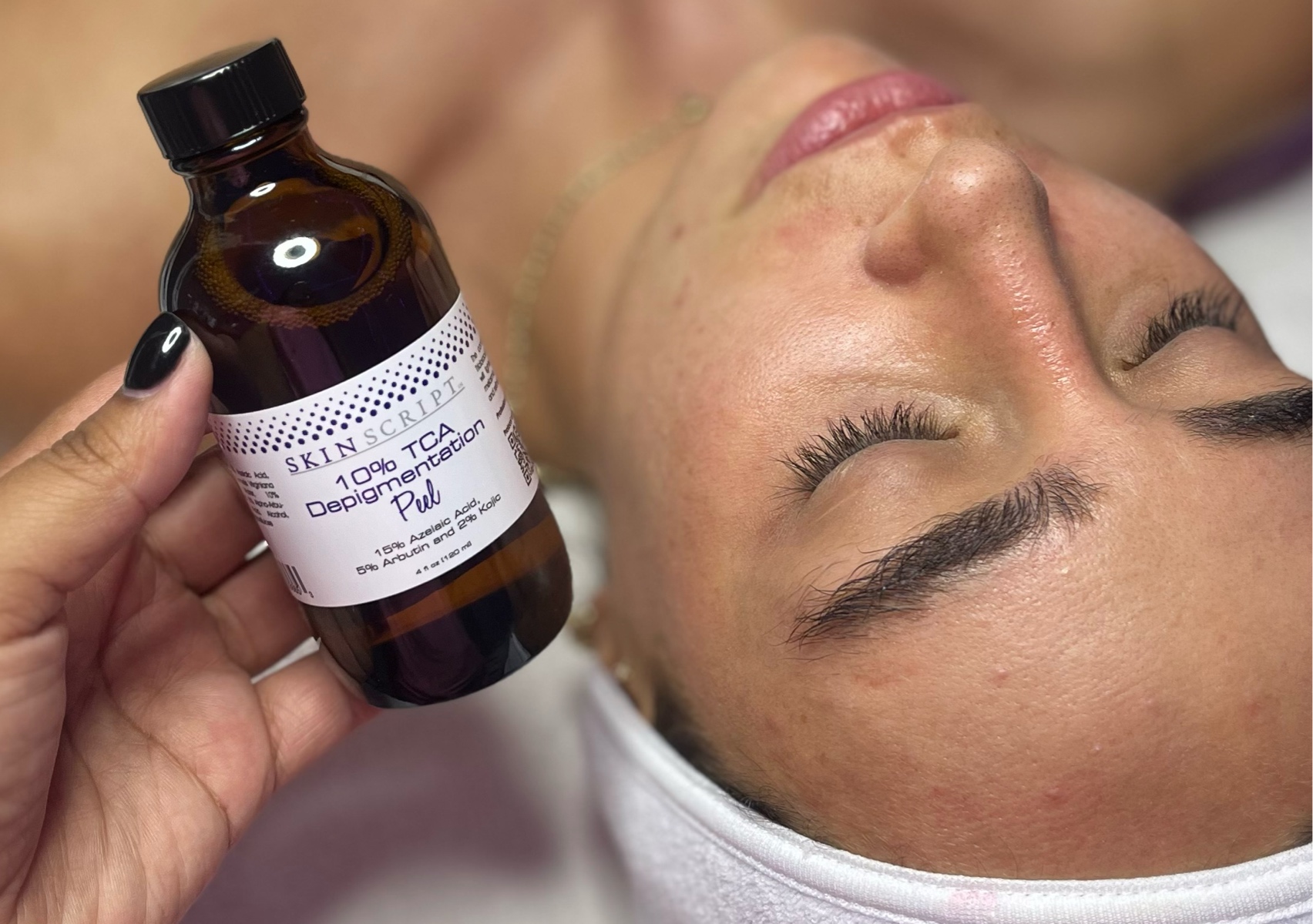 Tratamiento Exfoliación Quimica