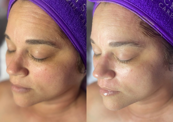 OxyGlow Treatment