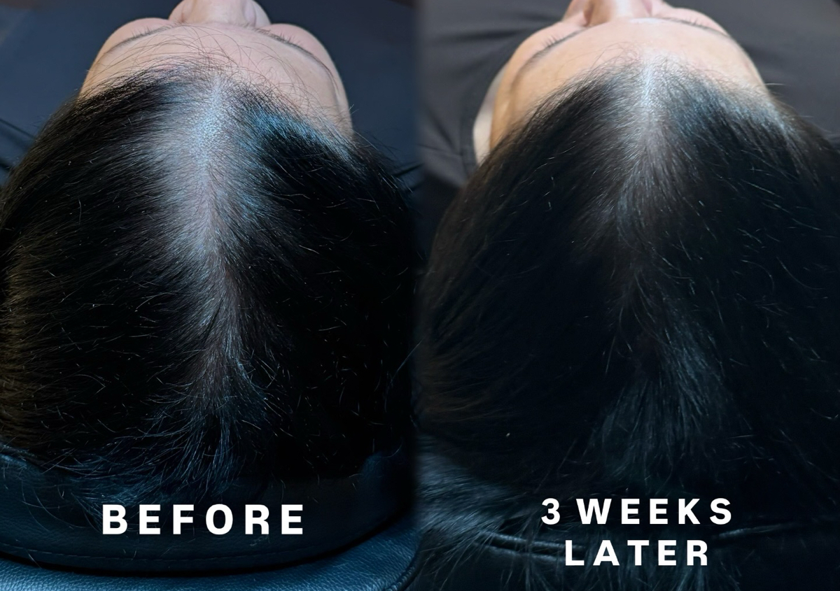1 x Signature Hairloss Treatment 