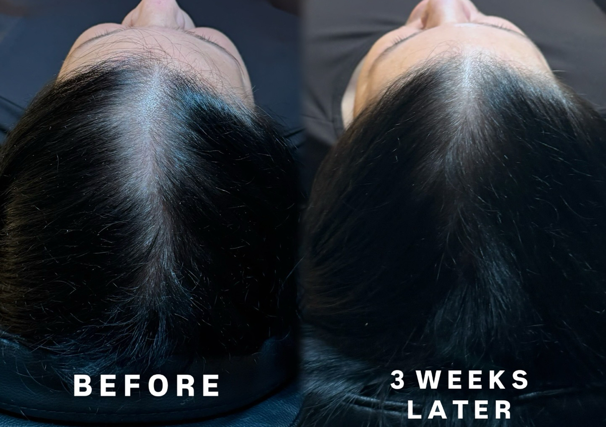 Signature Hair Loss 3 x Treatment
