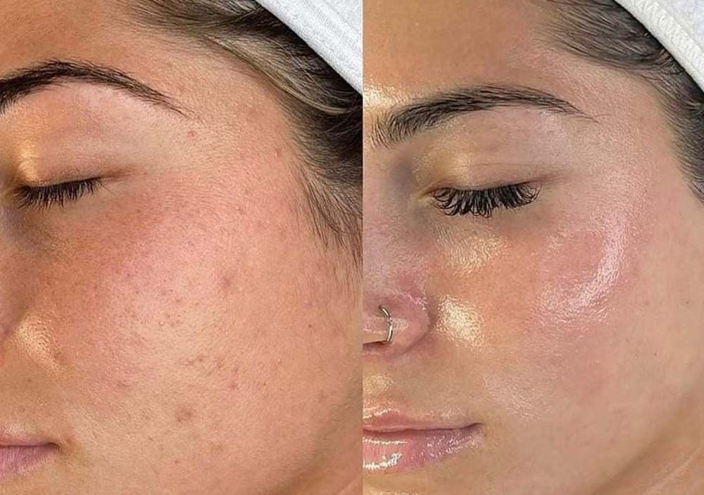 3 x Microneedling Session Package