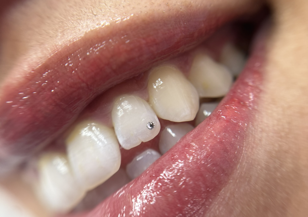 1 pieza gema dental