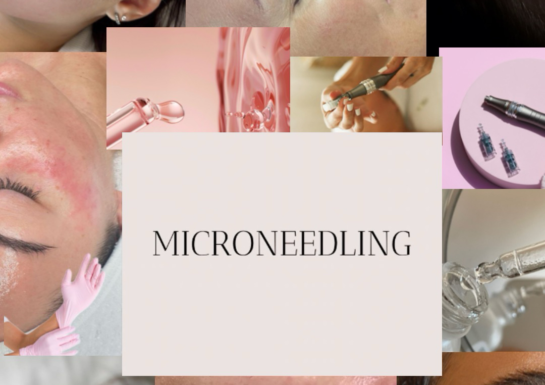 Block of 3 Microneedling sessions