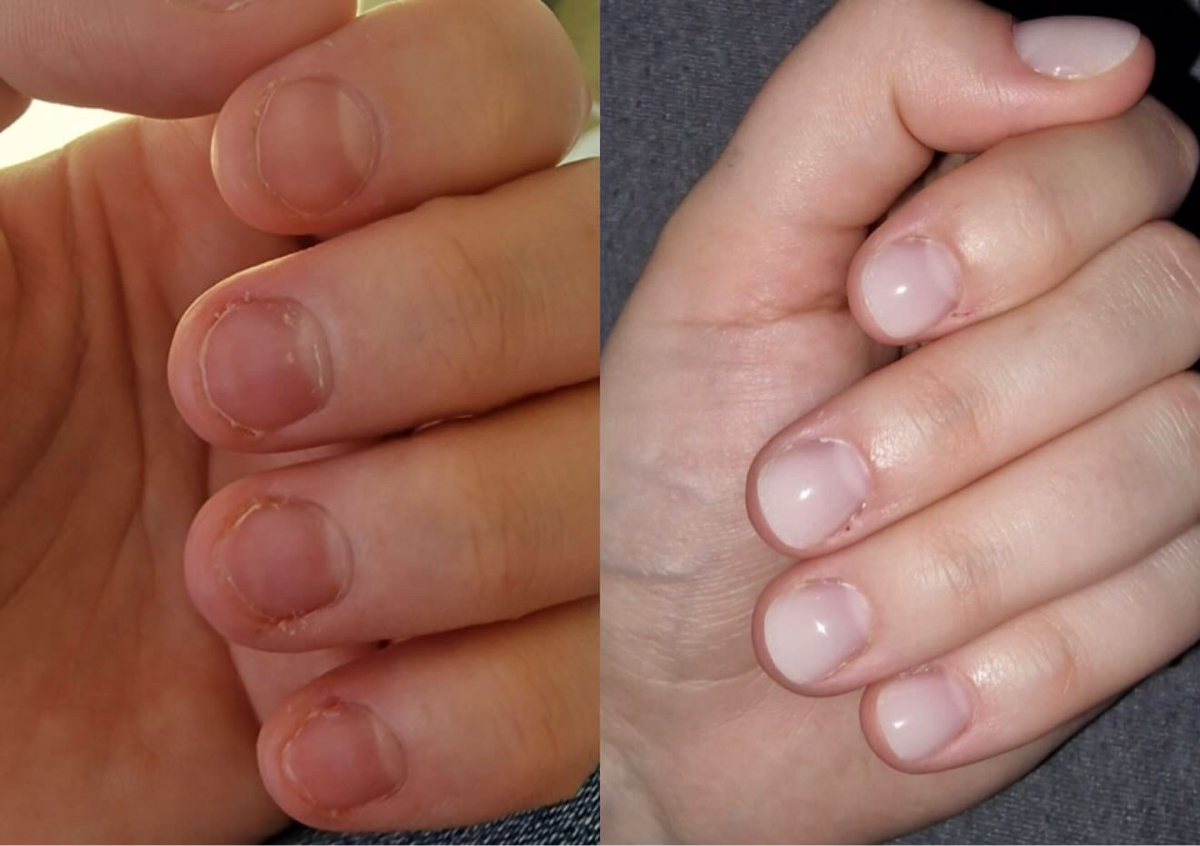 Protezare unghii roase