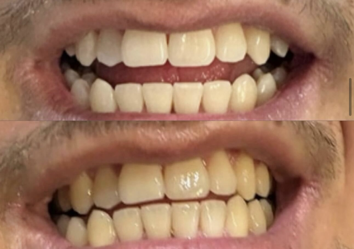 Couple teeth whitening 