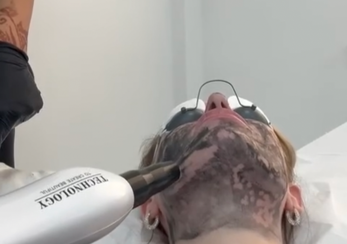 Carbon facial 