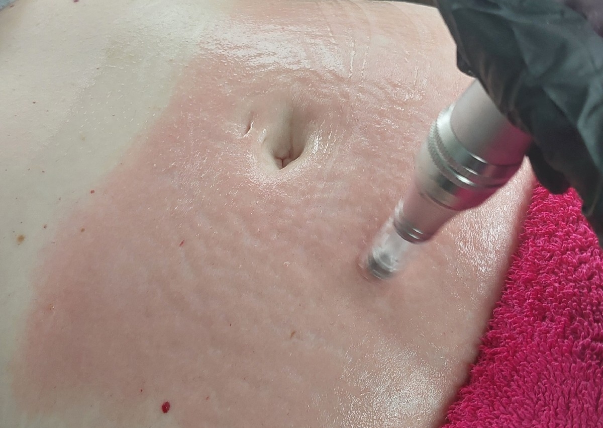 Stretchmark microneedling 