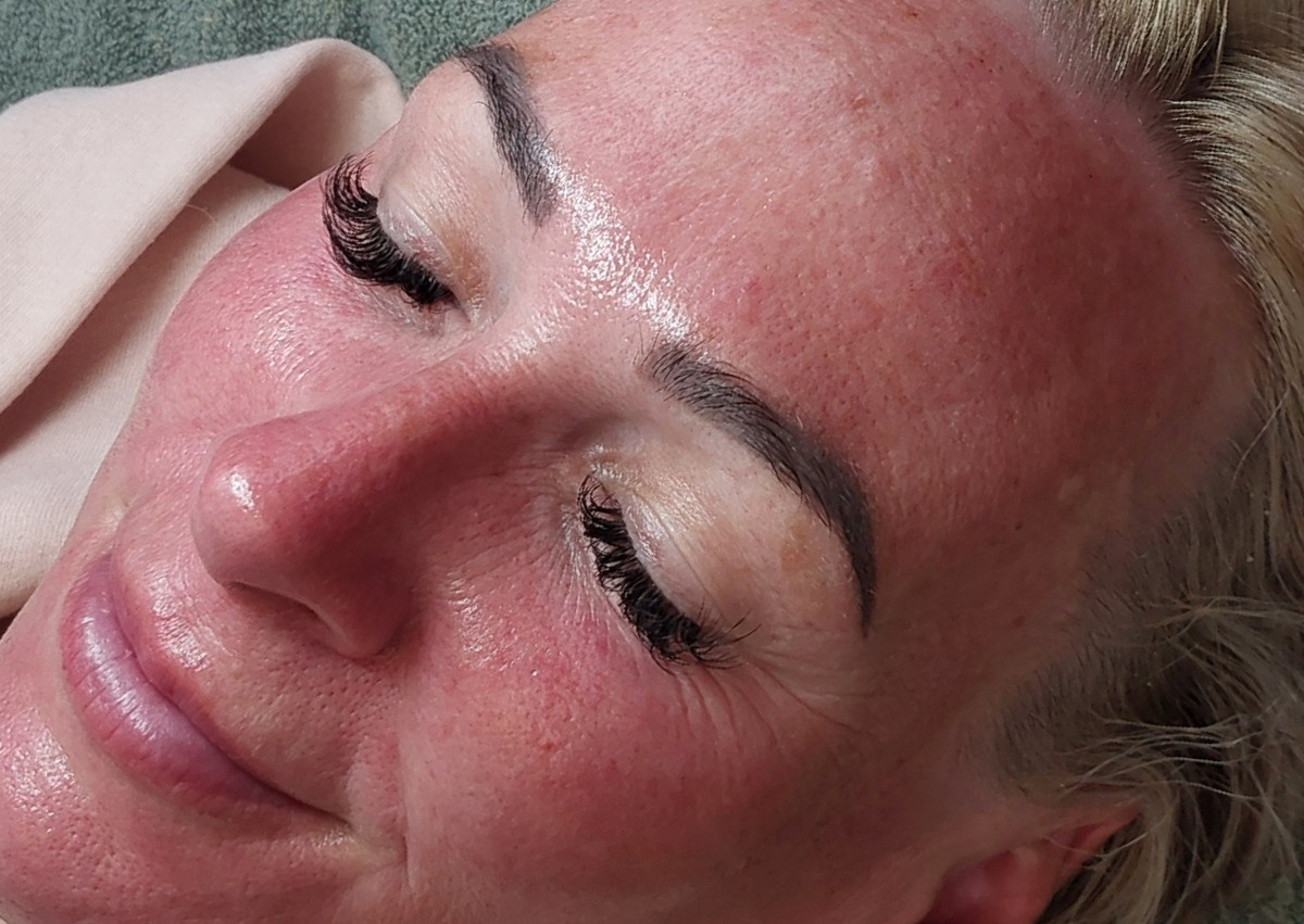 Vampire Facial