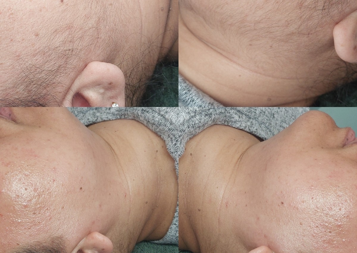 Dermaplaining Facial 