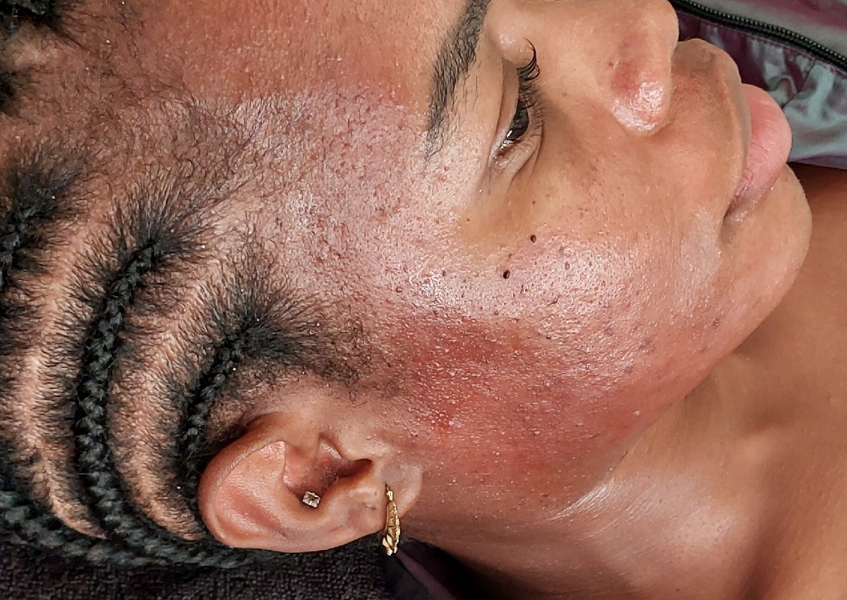 Microneedling Facial 