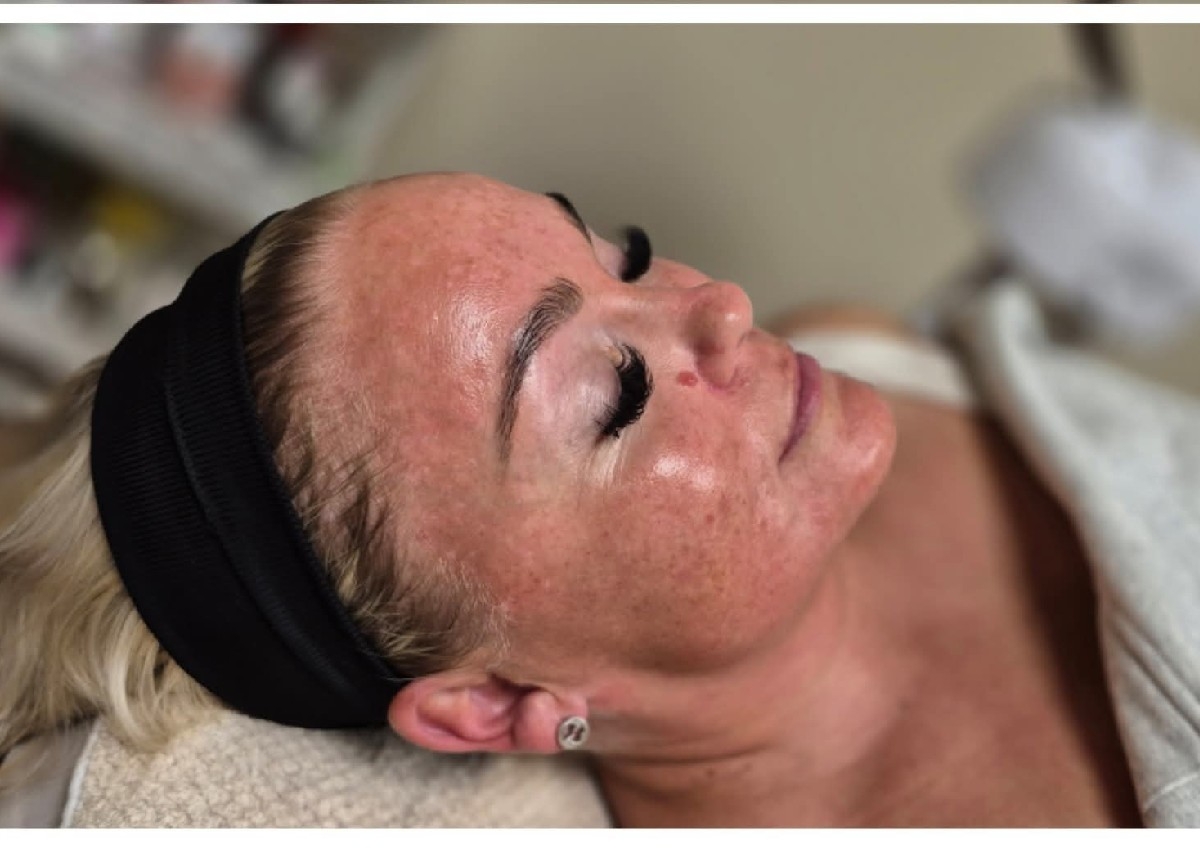 Microneedling & Dermaplaining 