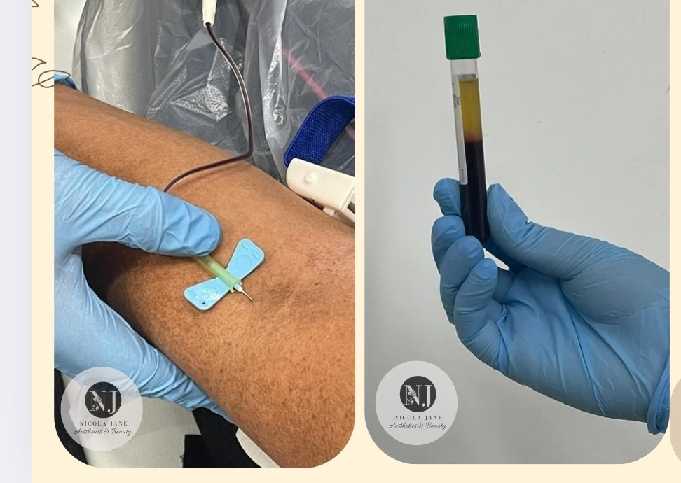 PRP  full face skin booster injections 